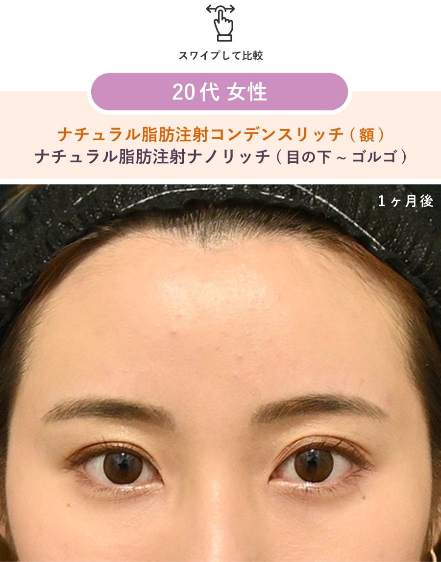 京都院 こめかみ・目の下 脂肪注入 術後