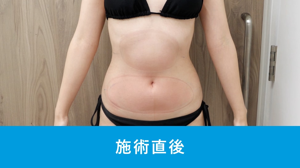 Q. ダウンタイムや施術後の過ごし方で、気をつけることはありますか？