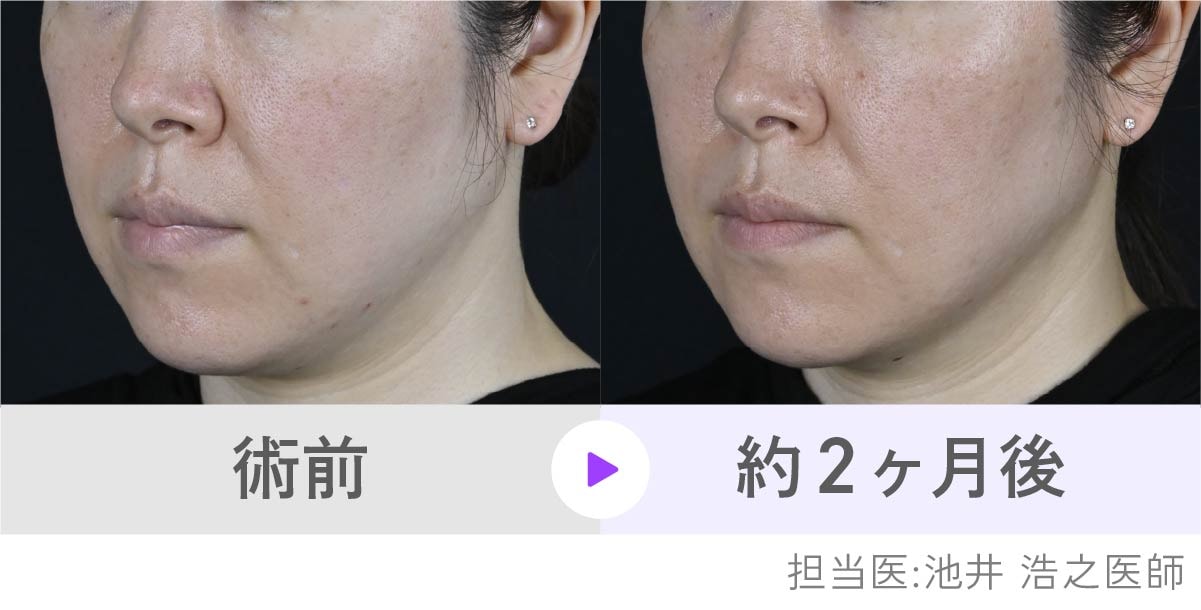 頬・フェイスラインのハリ感アップの症例