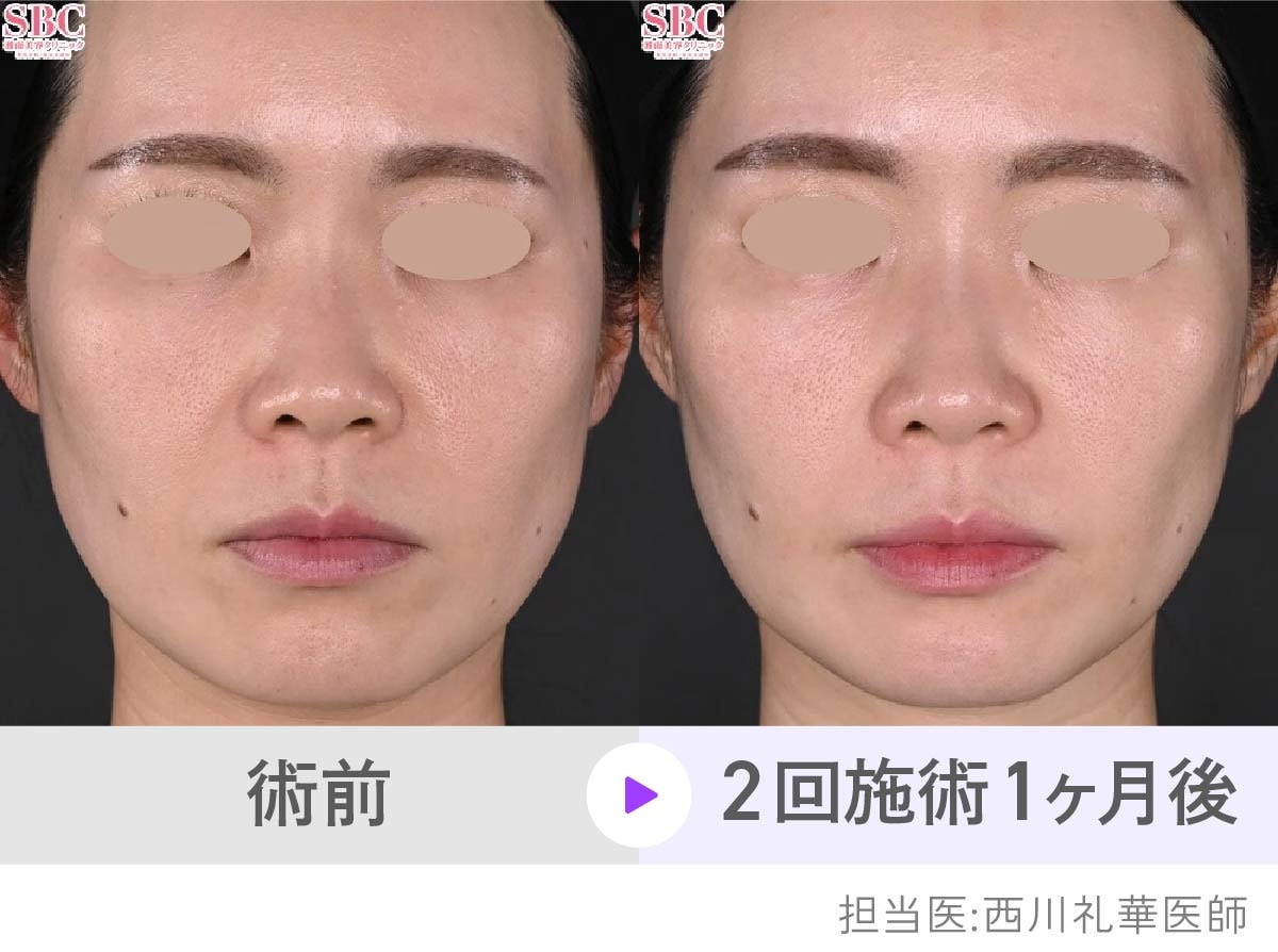 頬のハリ感UPでほうれい線も改善した症例