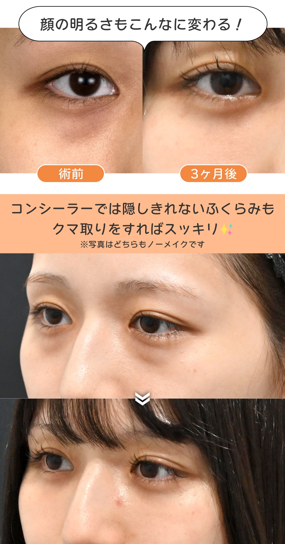 クマがないだけで印象はこんなに変わる！