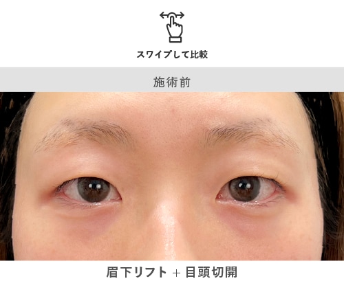 眉下リフト＋目頭切開 術前