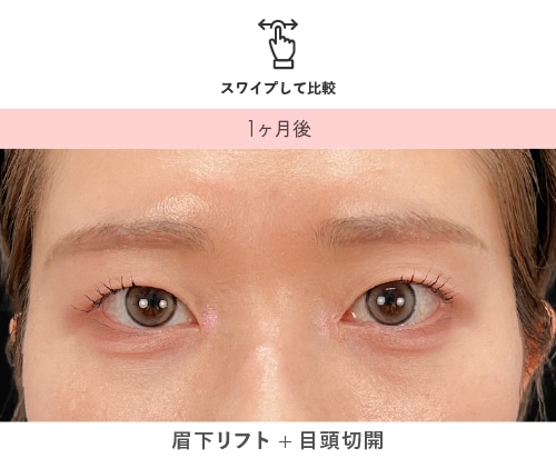 眉下リフト＋目頭切開 術後1ヶ月