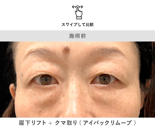 眉下リフト＋クマ取り 術前