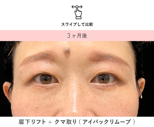 眉下リフト＋クマ取り 術後3ヶ月