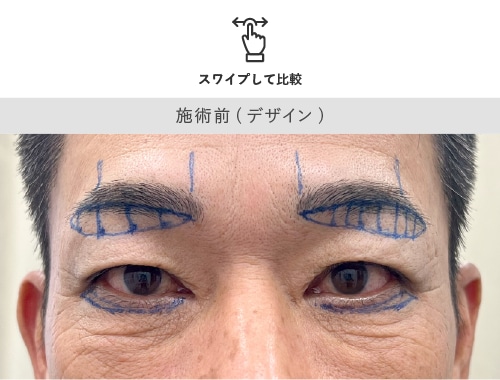 眉下リフト 施術前