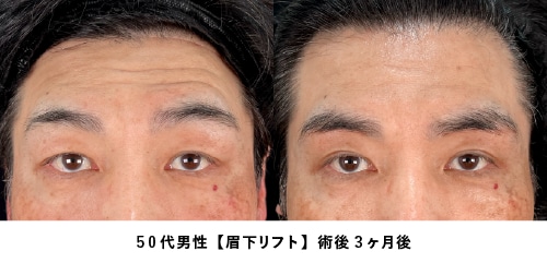 京都 眉下リフト 症例写真1（50代男性・たるみ取り）