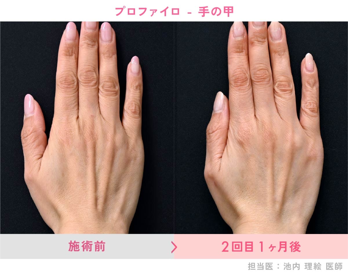 手の甲の症例