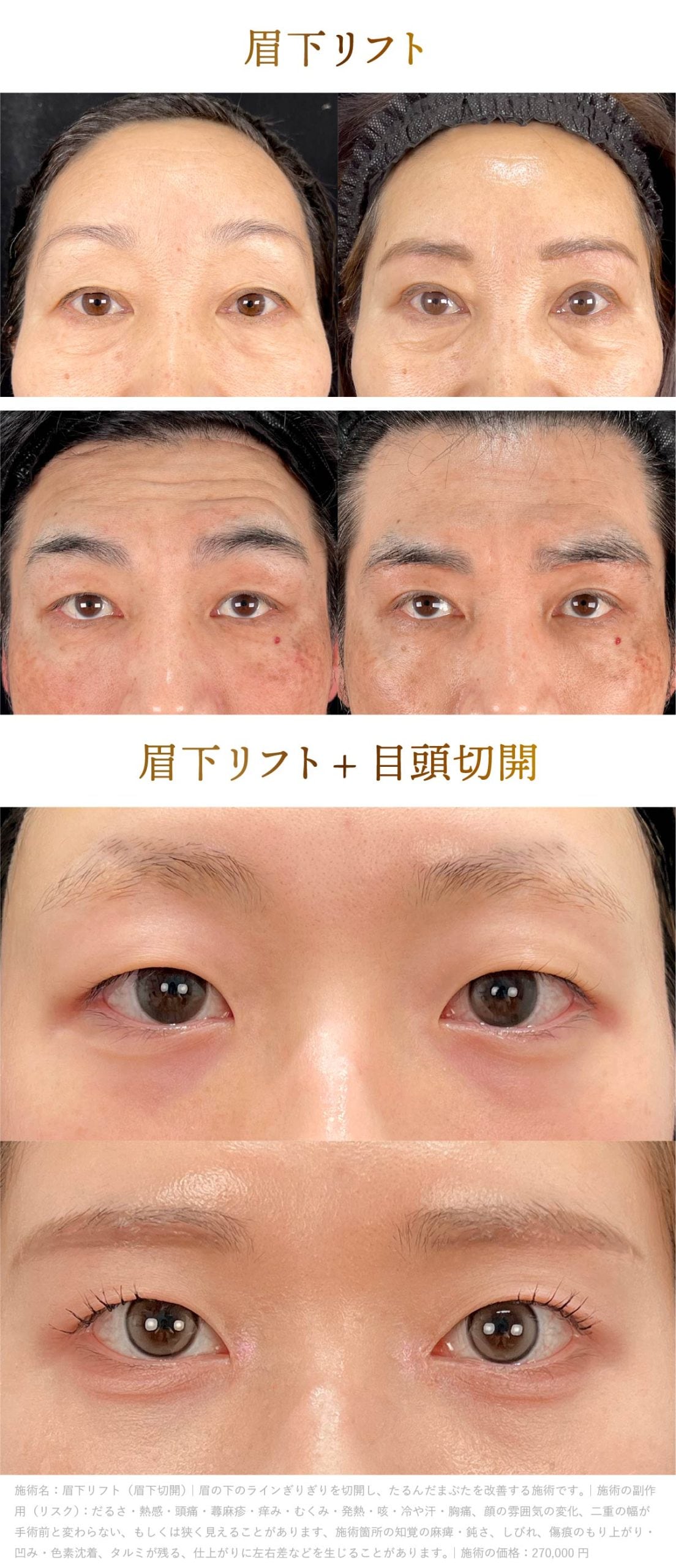 原田医師の眉下リフト症例画像