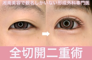 「全切開二重術」モニター募集