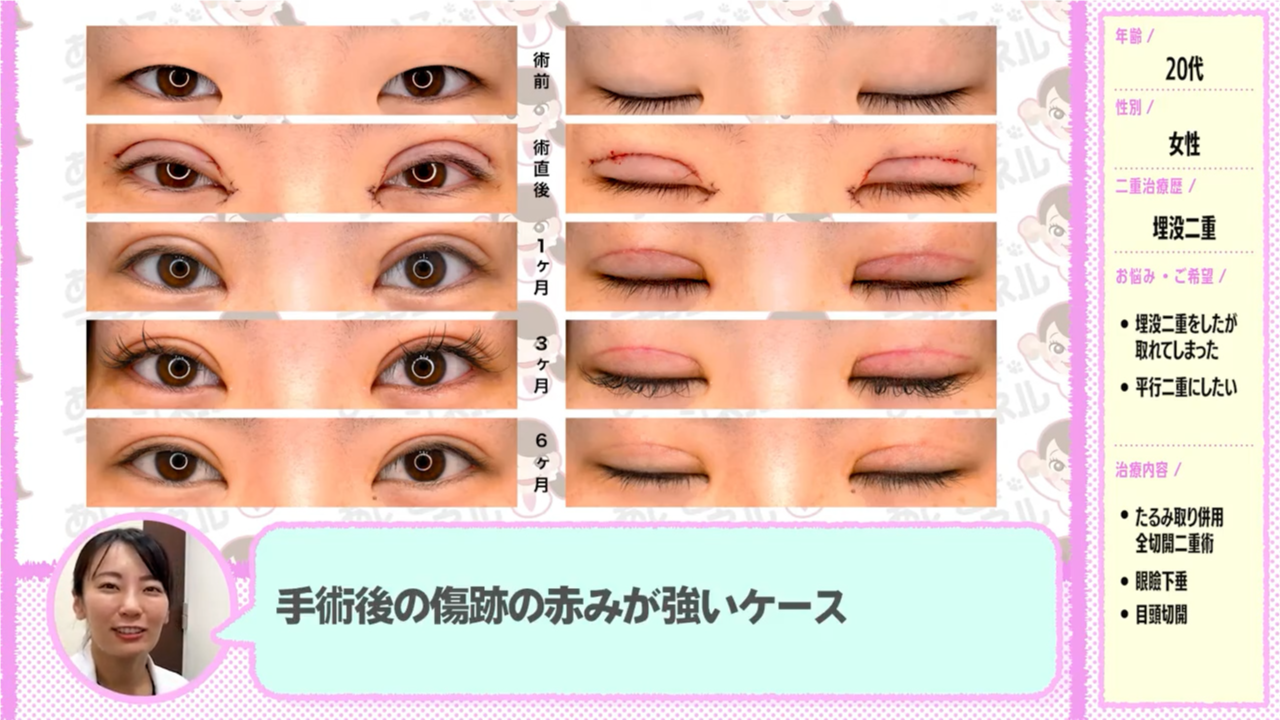 傷跡の「赤み」が強くて目立つ