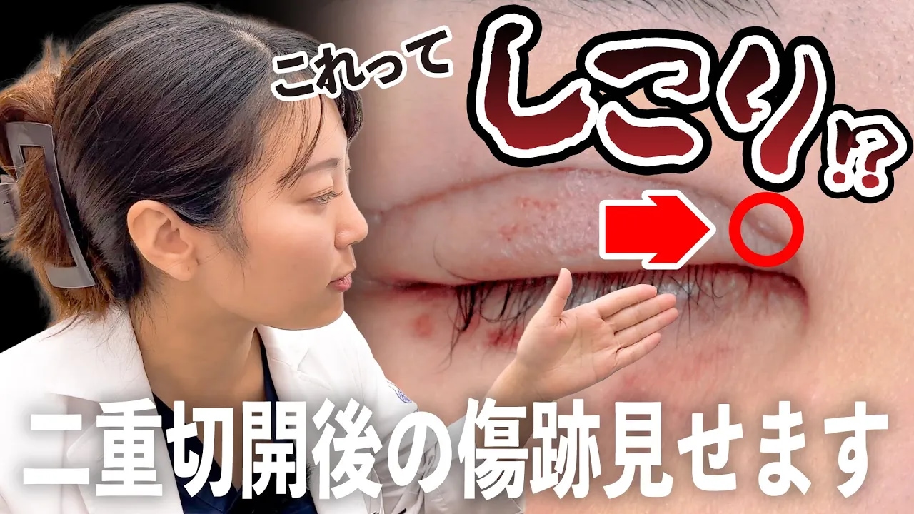 【医師が解説】二重切開失敗！？術後のしこりやハム目は治る？美容医療のプロが教えるリアルなダウンタイム