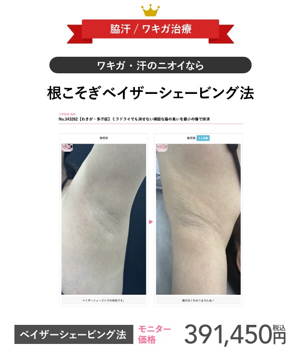 ランキング2位　脇汗治療根こそぎベイザーシェービング法