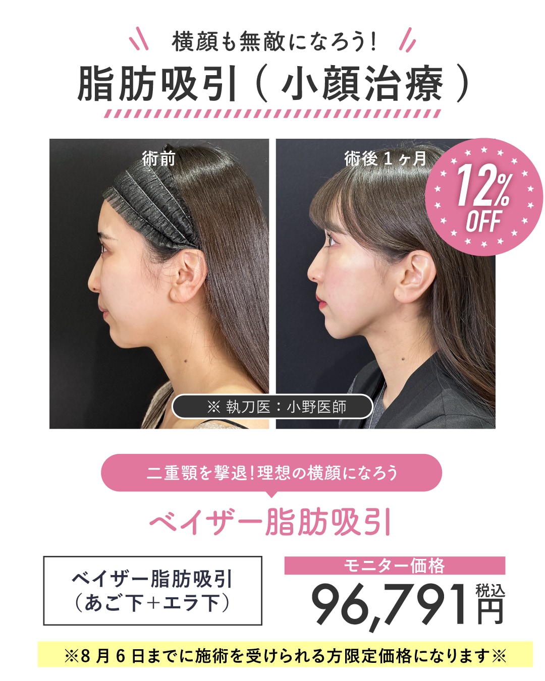 顔の脂肪吸引＋糸リフト（サクションリフト）