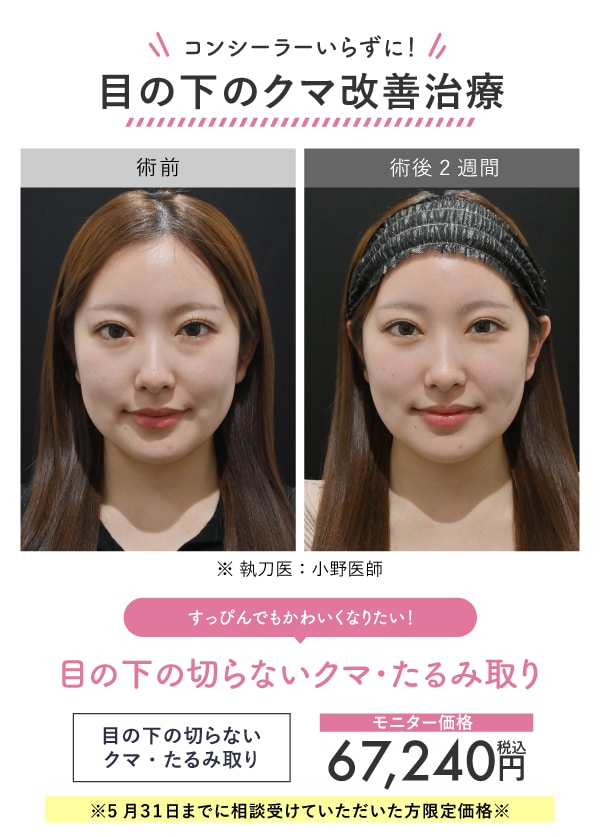 コンシーラーいらずの目元に！目の下のクマ改善治療