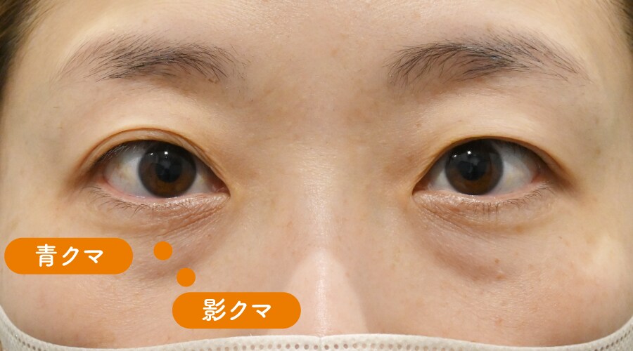 {目の下の切らないクマ取り} {30代}  {女性} の術前の症例写真