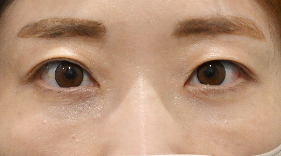 {目の下の切らないクマ取り} {30代}  {女性} の術後の症例写真