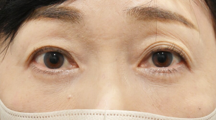 {目の下の切らないクマ取り} {50代}  {女性} の術後の症例写真