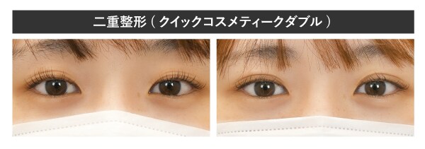 二重整形