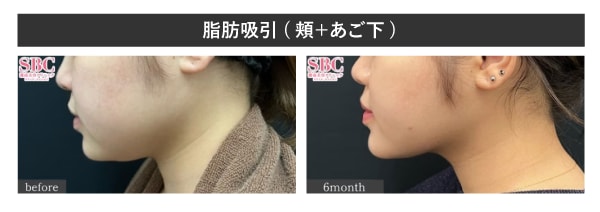 脂肪吸引