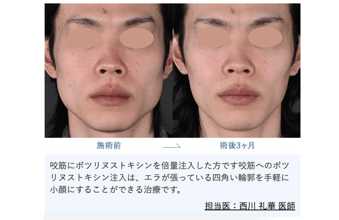 エラ