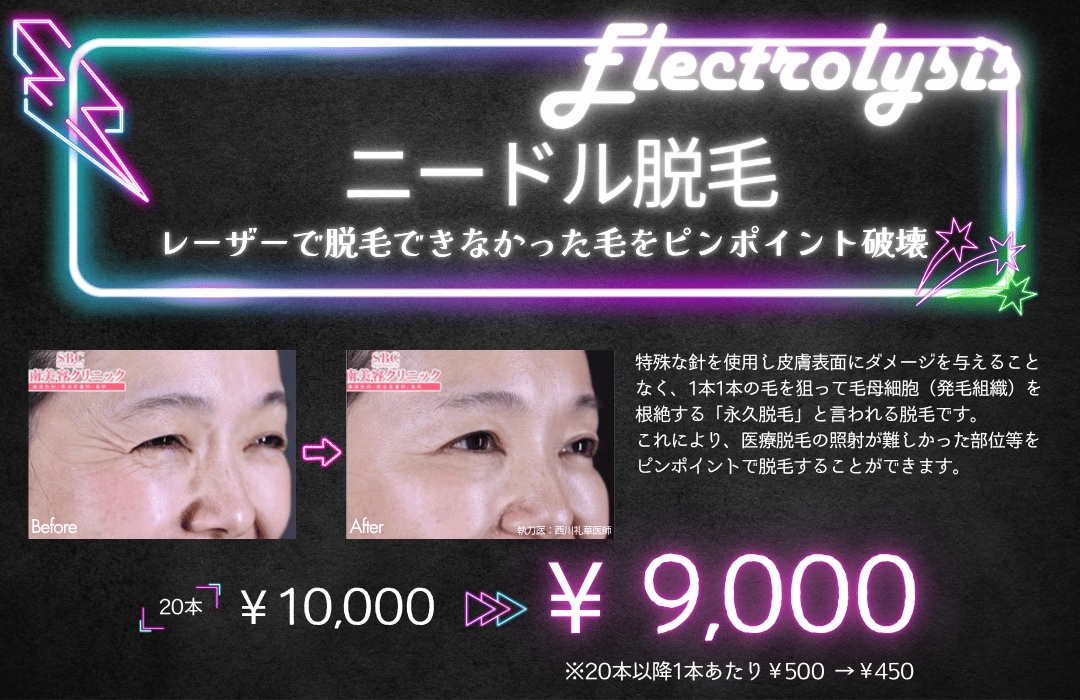 ニードル脱毛