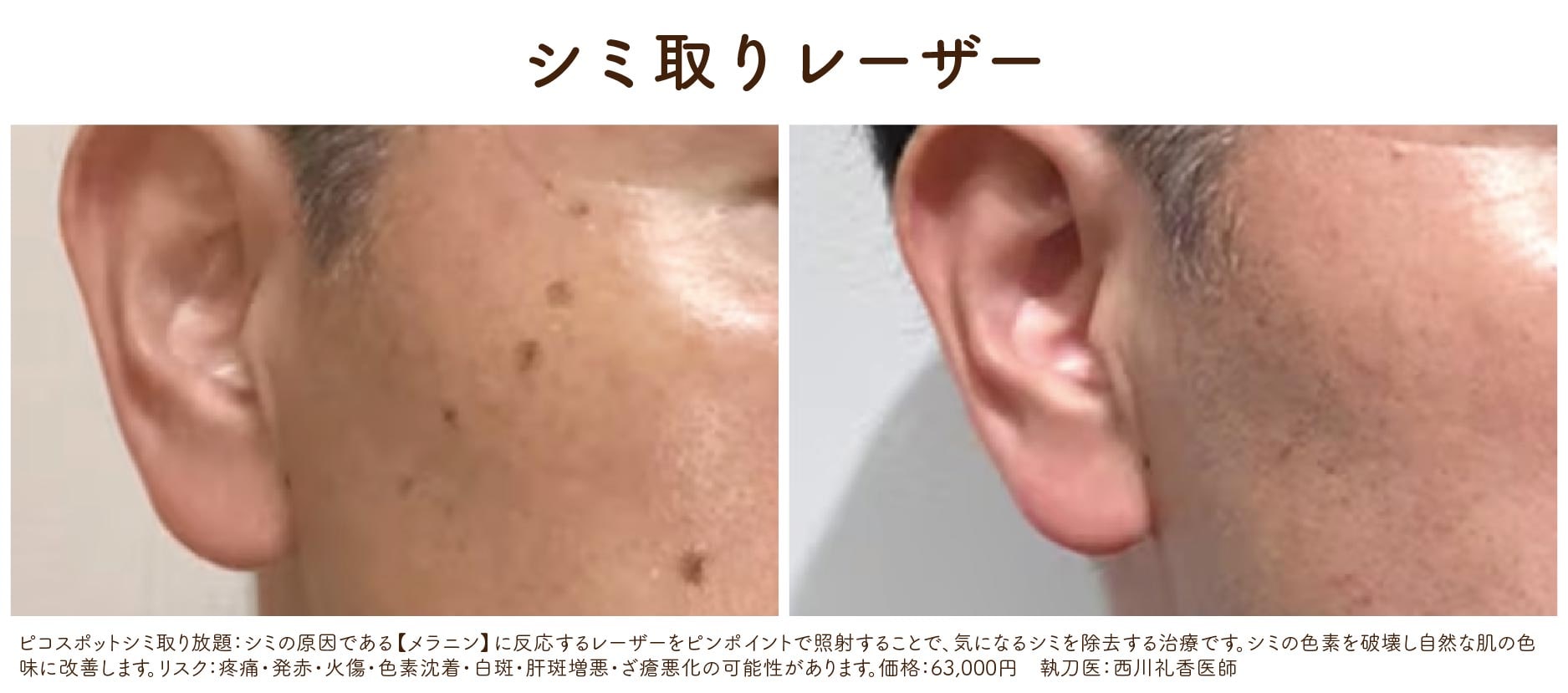 シミ取り(ピコスポットシミ取り放題・シミ取りレーザー10)