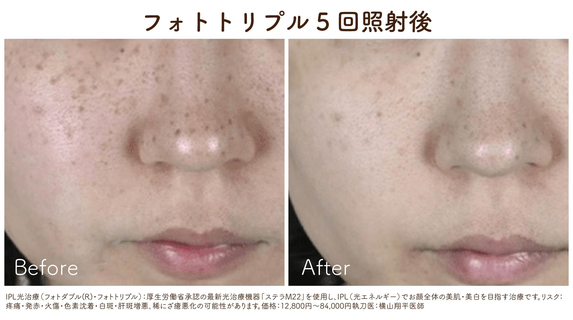 IPL光治療(フォトダブル・フォトトリプル)