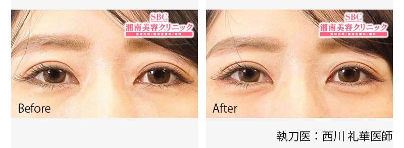 涙袋