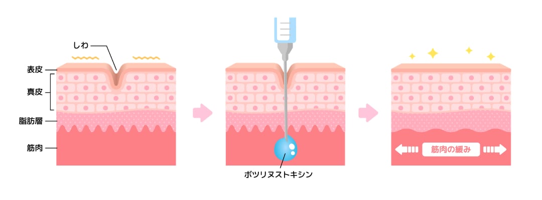 シワの正体は「筋肉の動き」だからスキンケアでは消えない