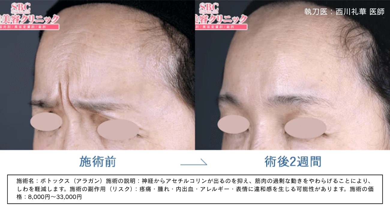 眉間のシワ（縦ジワ・印象改善）