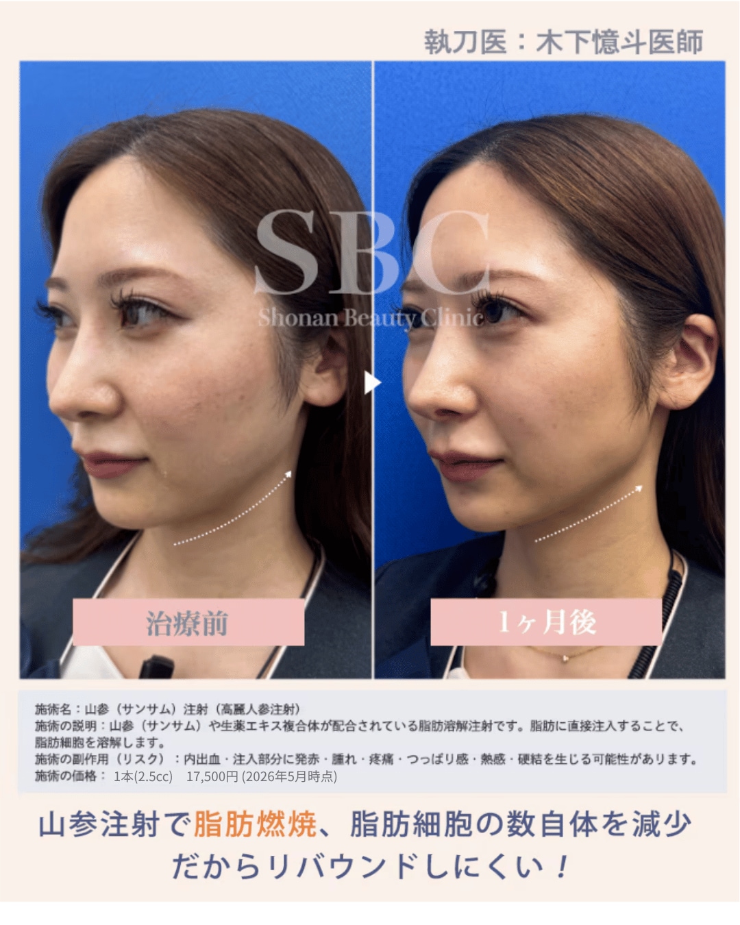 SBCの山参は原液(薄めず)の量・価格