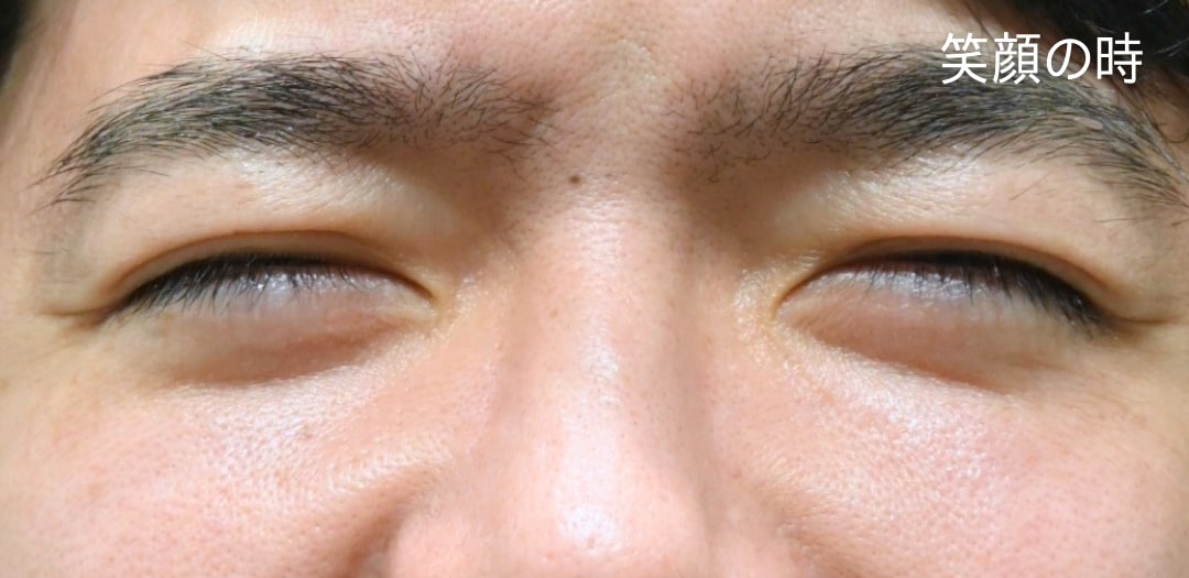 術後