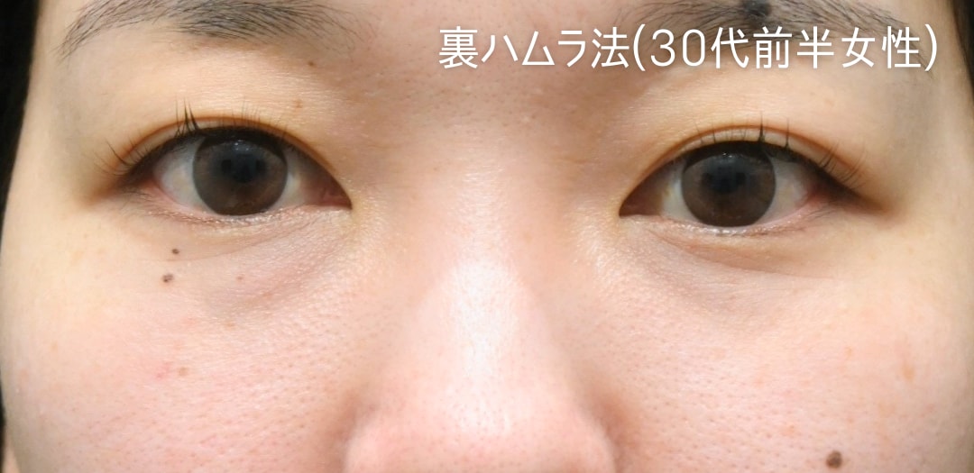 術前