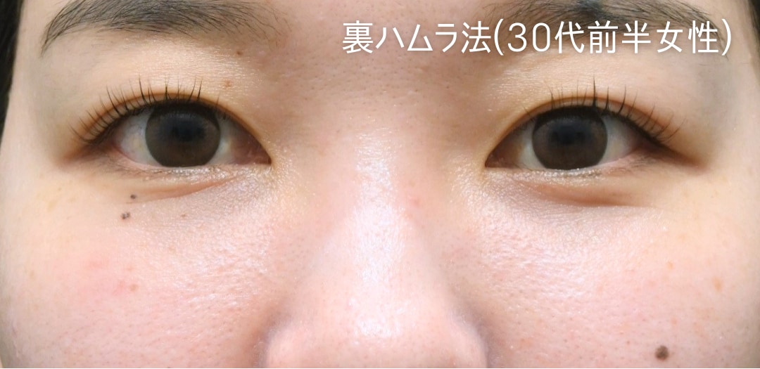 術後