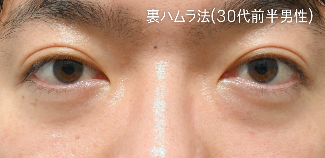 術前
