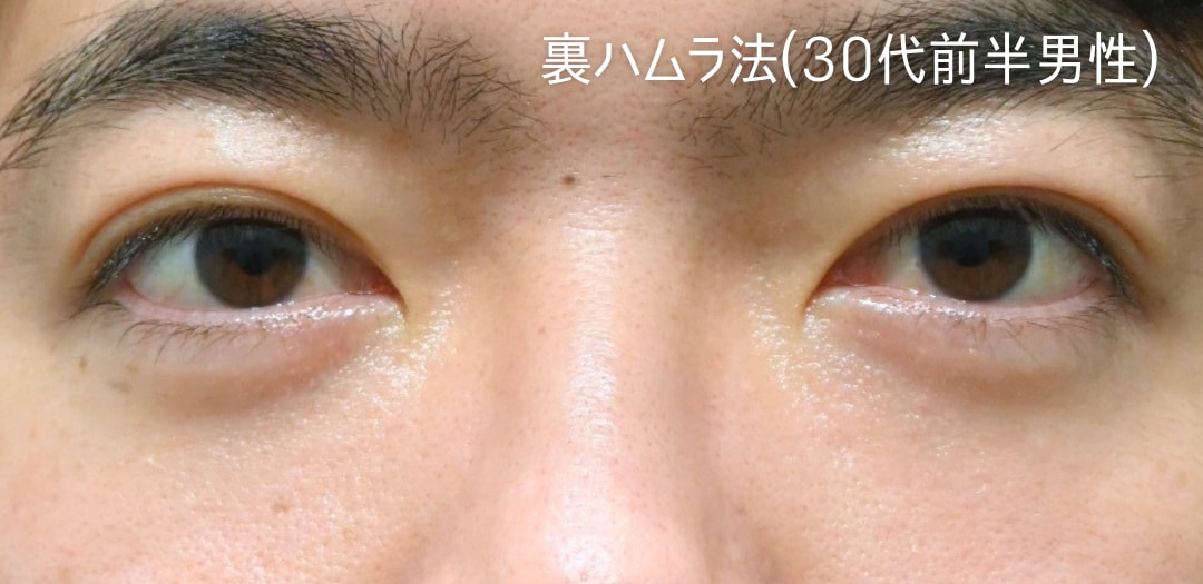 術後