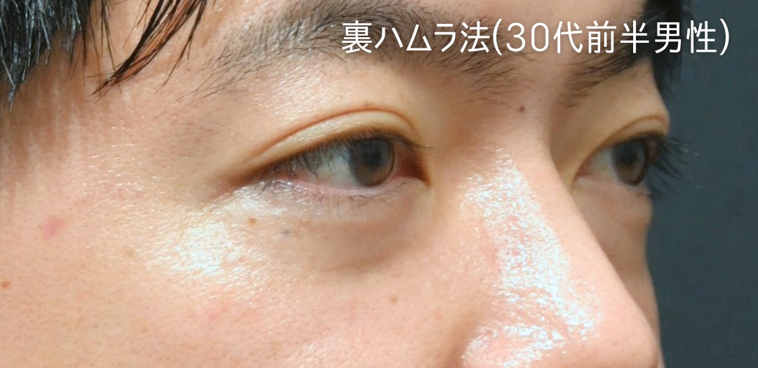 術前