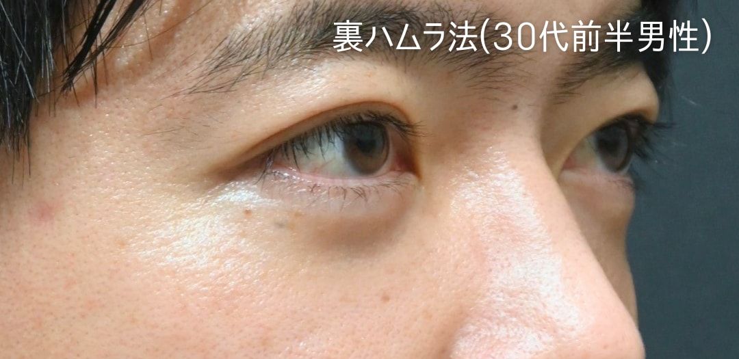 術後