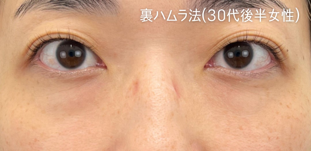 術前