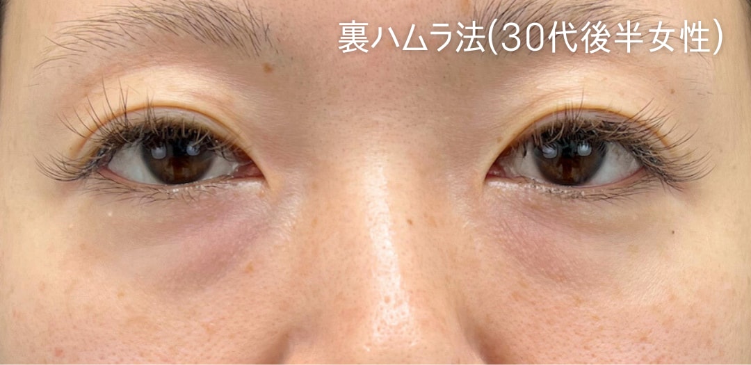 術前
