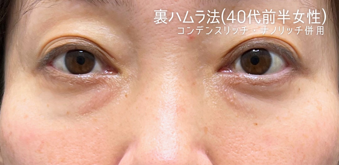 術前