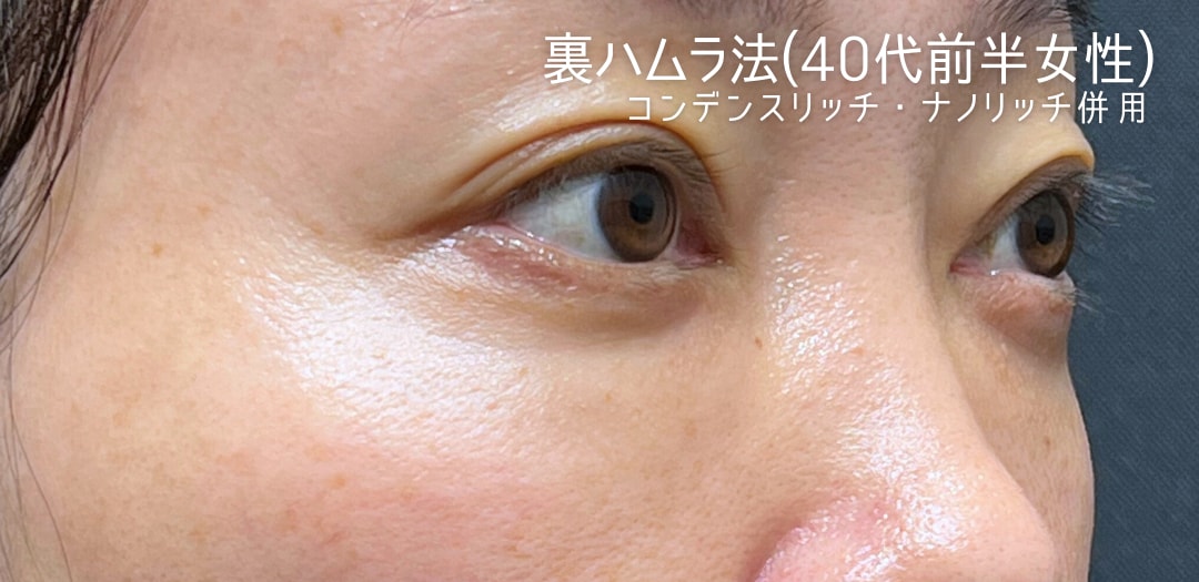術後