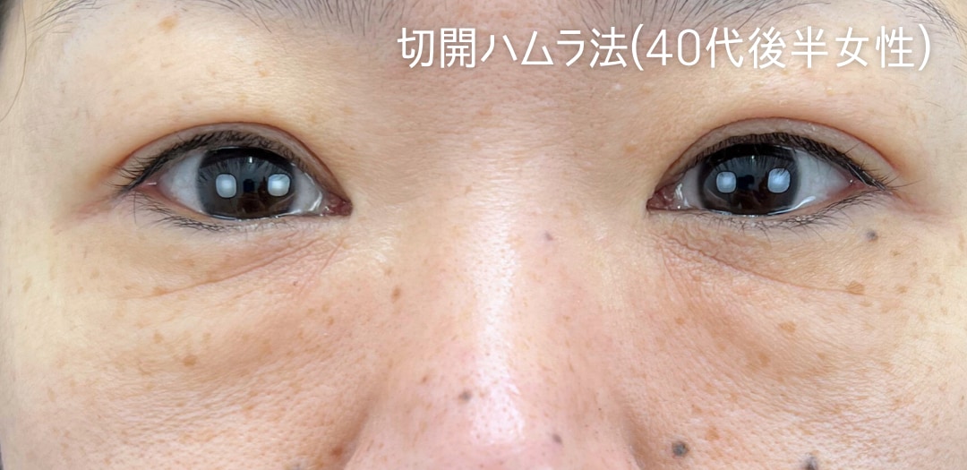 術前