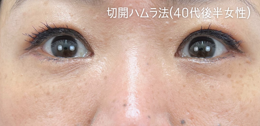 術後