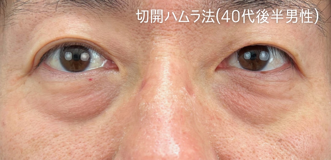 術前