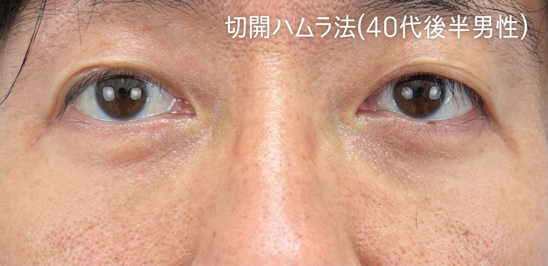 術後
