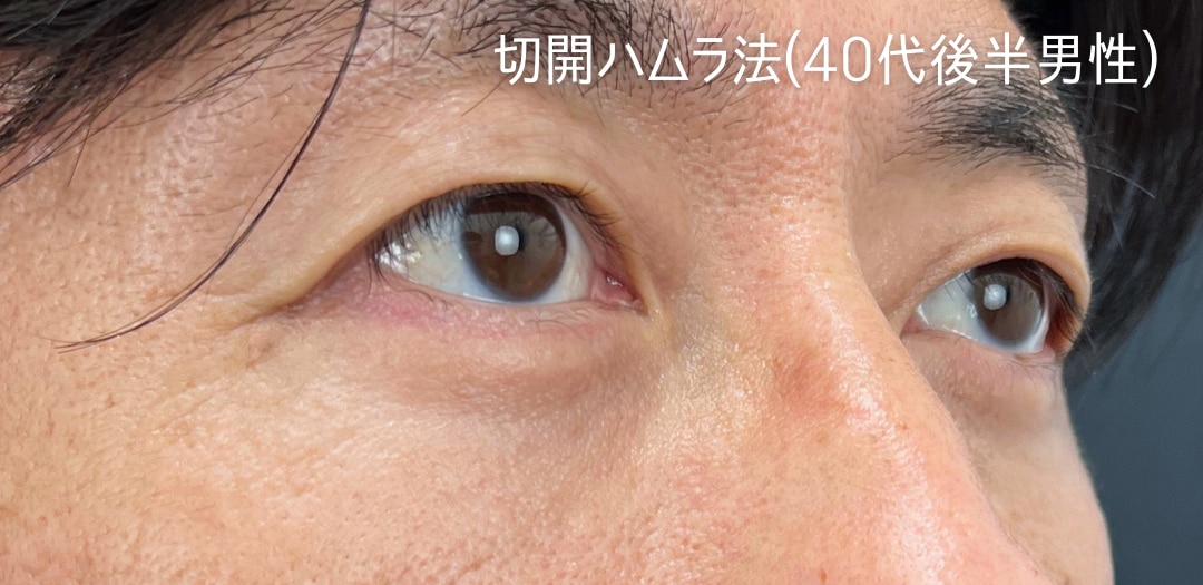 術後