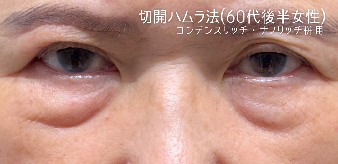 術前