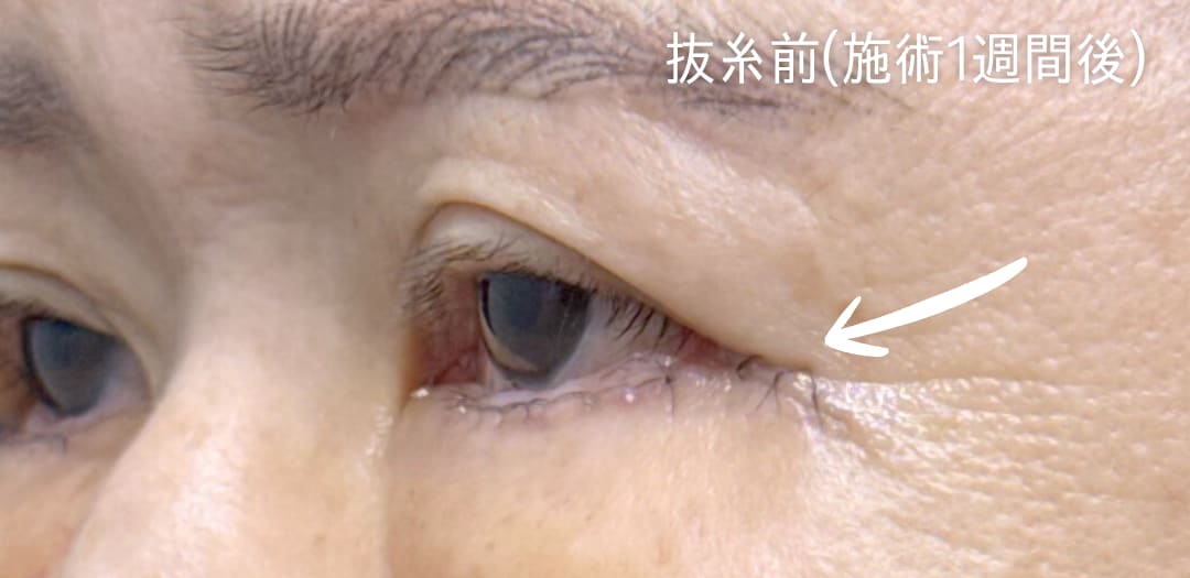 術前